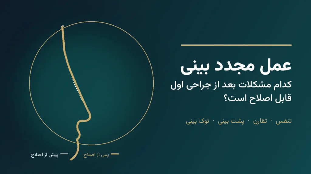 طرح گرافیکی نیم‌رخ بینی پیش و پس از اصلاح، با عنوان عمل مجدد بینی